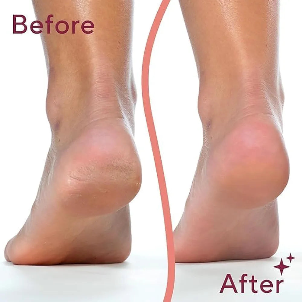 Electric Foot Callus Remover