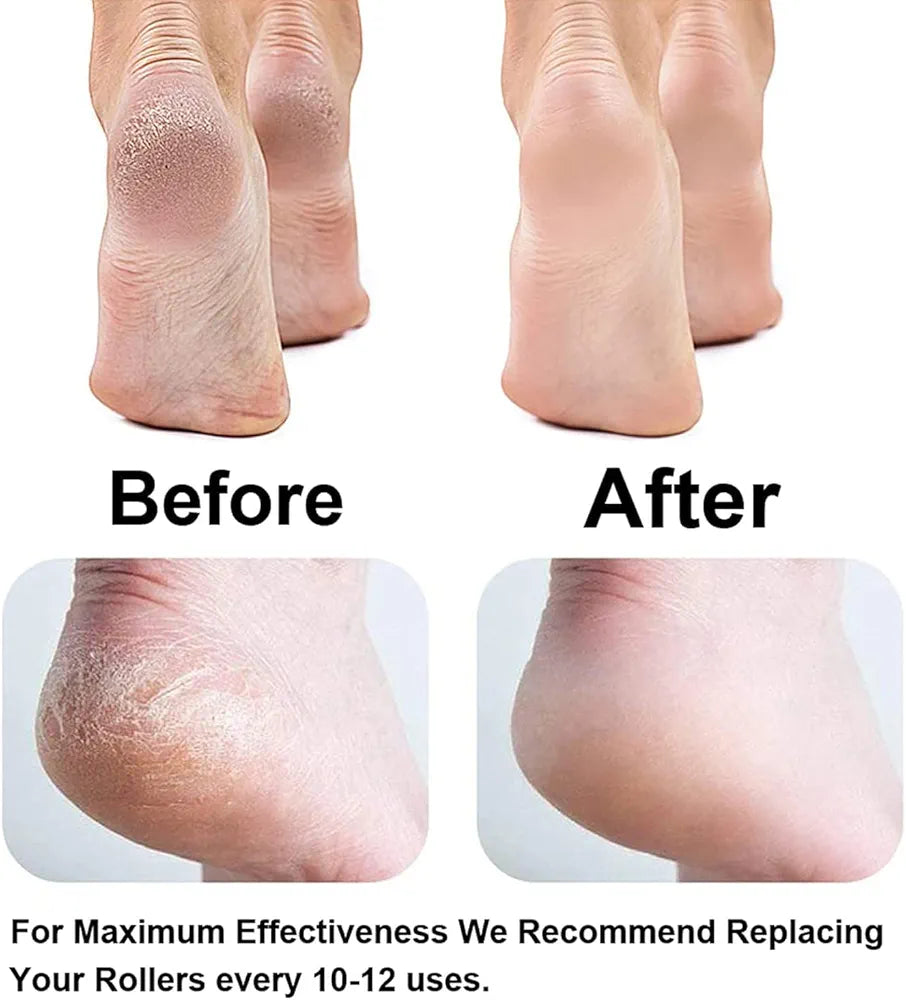 Electric Foot Callus Remover